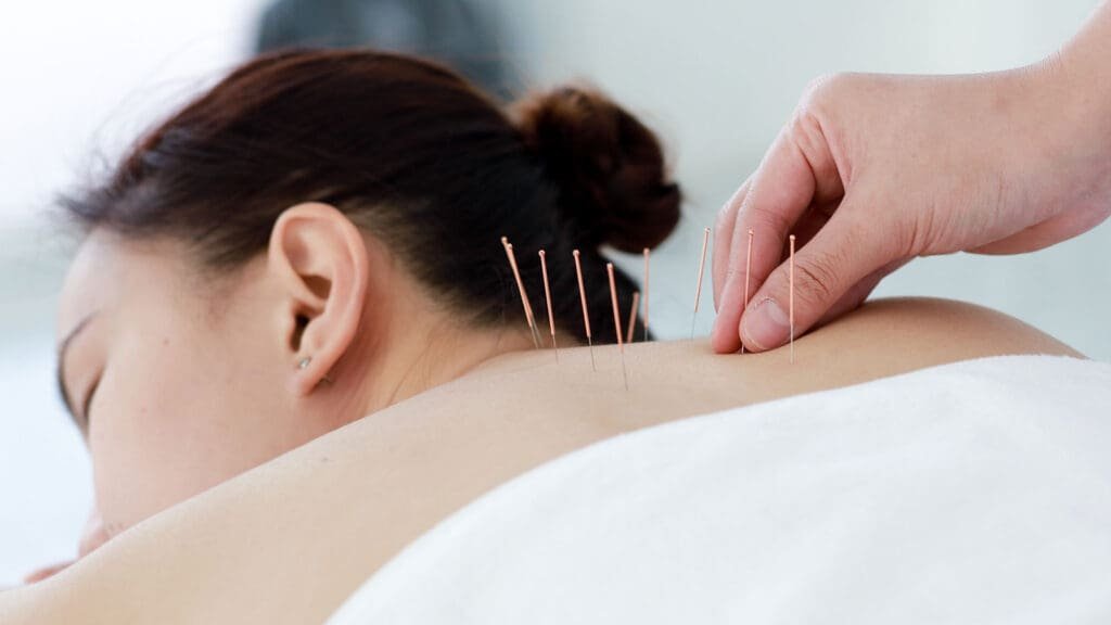 Acupuncture in Langley