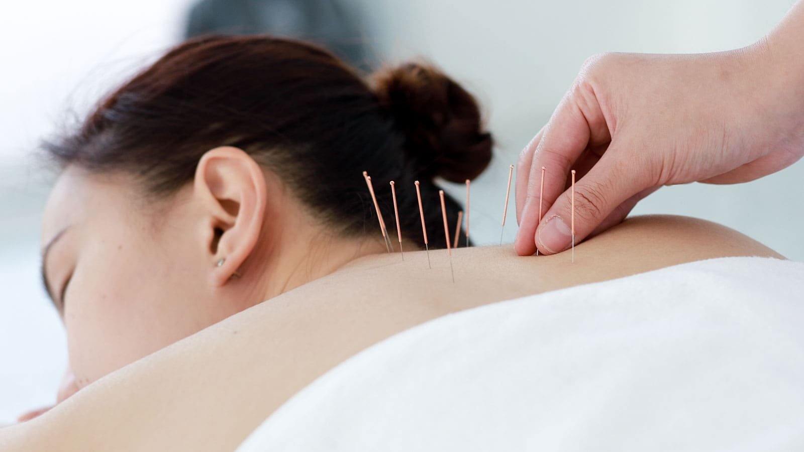 Acupuncture treatment in Langley clinic