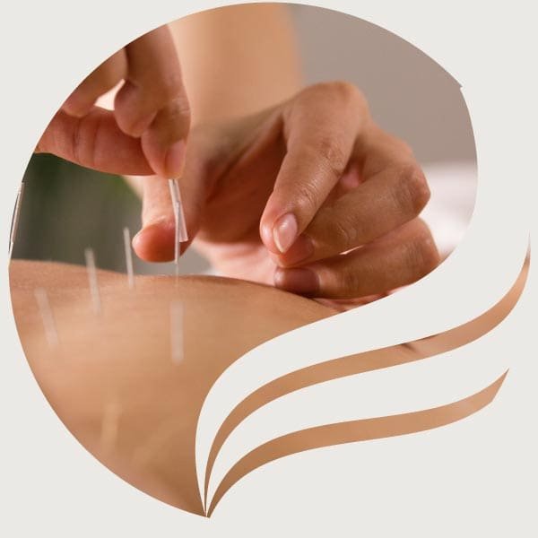 Acupuncture needles in patient’s back in Newton Surrey