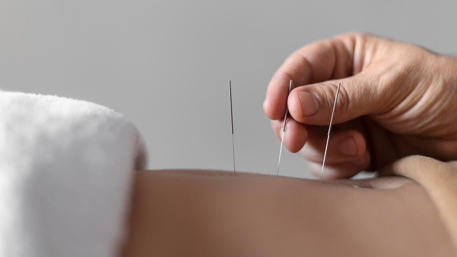 Acupuncture needles for chronic pain treatment in Langley