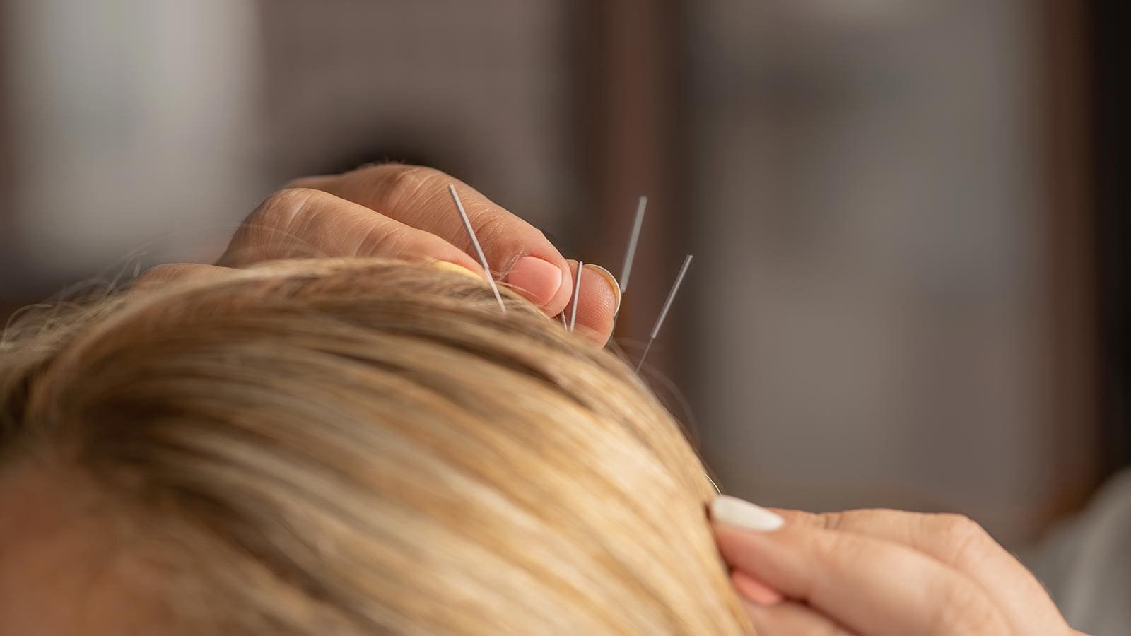 Migraine acupuncture treatment